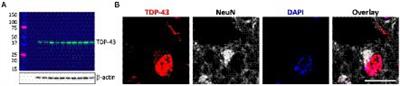 ATP-binding cassette transporter expression is widely dysregulated in frontotemporal dementia with TDP-43 inclusions